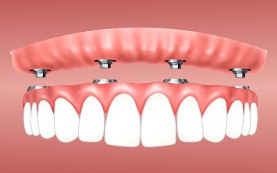 ¿Cuánto tiempo duran unos implantes dentales?