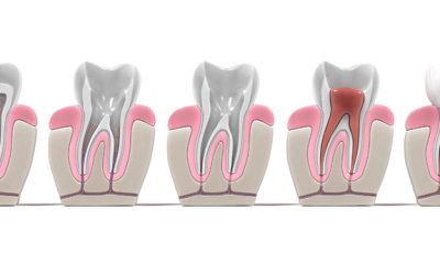 ¿Qué es la desvitalización dental y cuándo es necesaria?